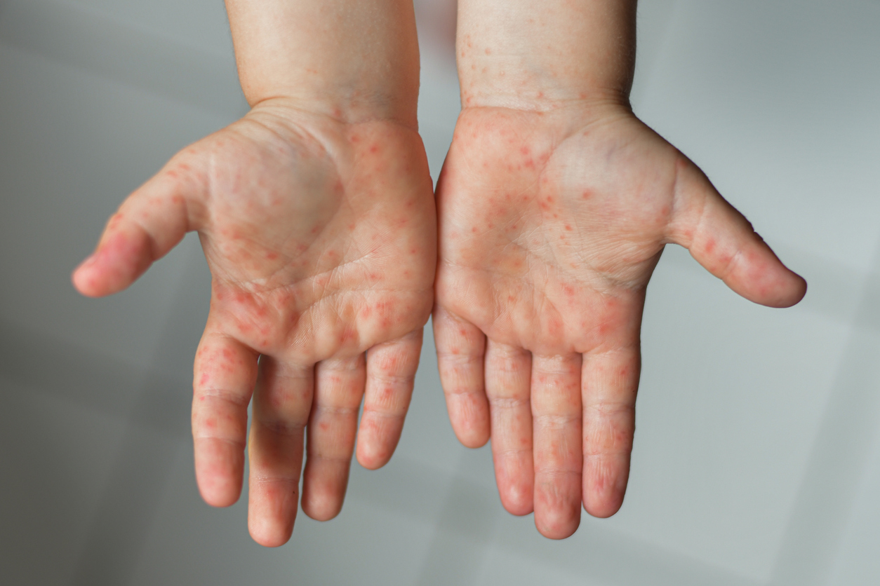Why do adults seem to suffer from a more severe form of chicken pox or HFMD when they get infected?