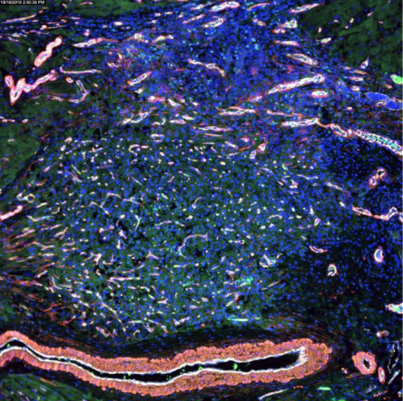 Newly formed large tissue made of engrafted human stem cells (in green) and blood vessels (in white) seen near existing heart muscles (in red) // Credit: Lynn Yap