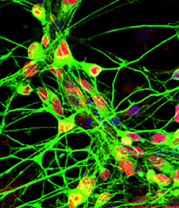 Zhang Suchun uses h for cell therapy in Parkinson’s disease. Green indicates tyrosine hydroxylase (an enzyme for synthesising dopamine) and red signals midbrain transcription factor engrailed in the dopamine neurons // Credit: Zhang Suchun