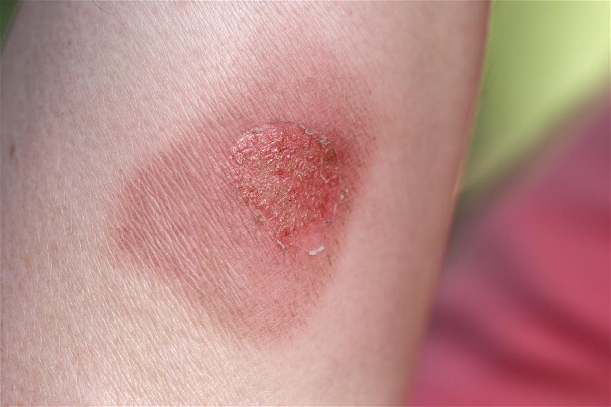 What happens to our cells and tissues when we experience burns?