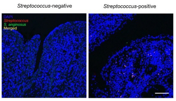 Detection of oral bacteria (red and green dots) in gastric cancer tissue. // Image credit: Lee Kong Chian School of Medicine