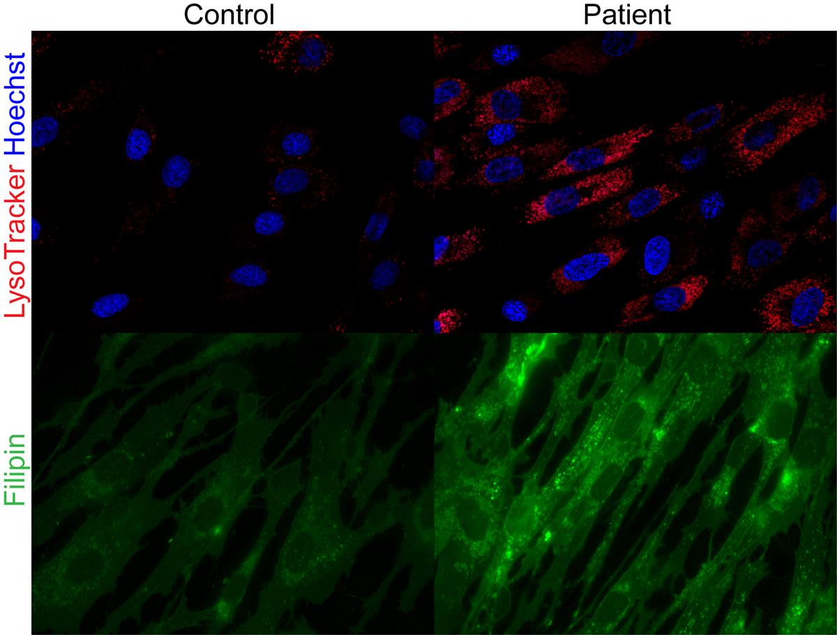 Skin fibroblasts in a healthy individual (left) and skin fibroblasts with enlarged lysosomes and cholesterol build-up in in a patient with SPNS1 mutations (right). // Credit: Duke-NUS Medical School