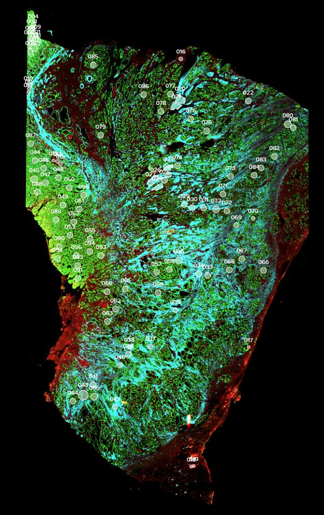 Gastric tumour tissues under a microscope. Each circle represents a tumour microregion that the researchers analysed. // Image credit: Ma Haoran, Duke-NUS Medical School