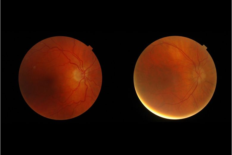 Images of the ocular fundus (inside, back surface of the eye) showing the optic nerve head - the region where the blood vessels converge - in a normal patient (left) and in a patient with subtle abnormalities associated with a brain tumour. 