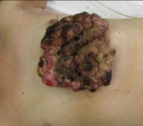 fungating-wound